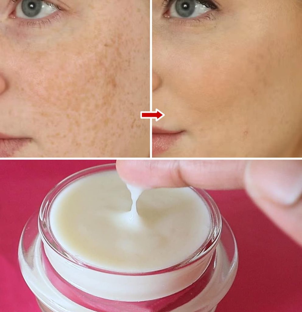 Simply add this simple ingredient to your face cream to clear up skin blemishes