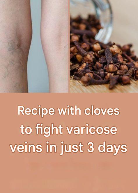 11 Home Remedies for Your Varicose Veins