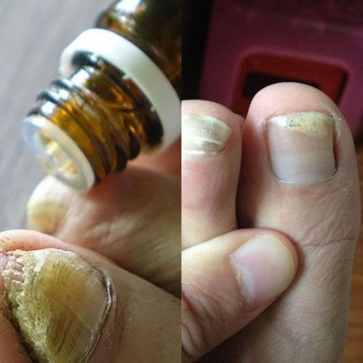 Natural power in the fight against nail fungus: essential oils as an effective solution