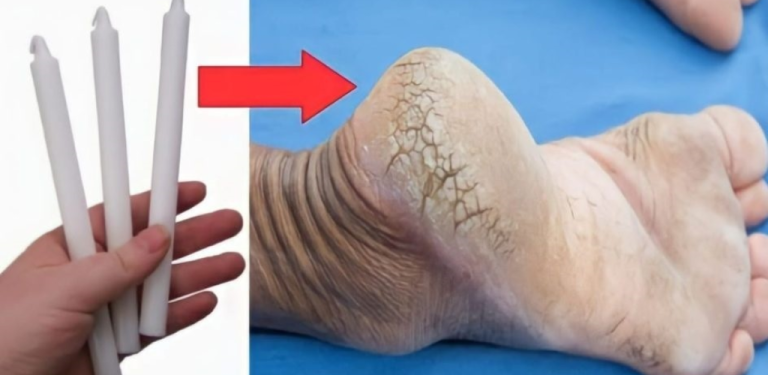 Cracked heels, with the candle trick you get rid of them in just 1 day