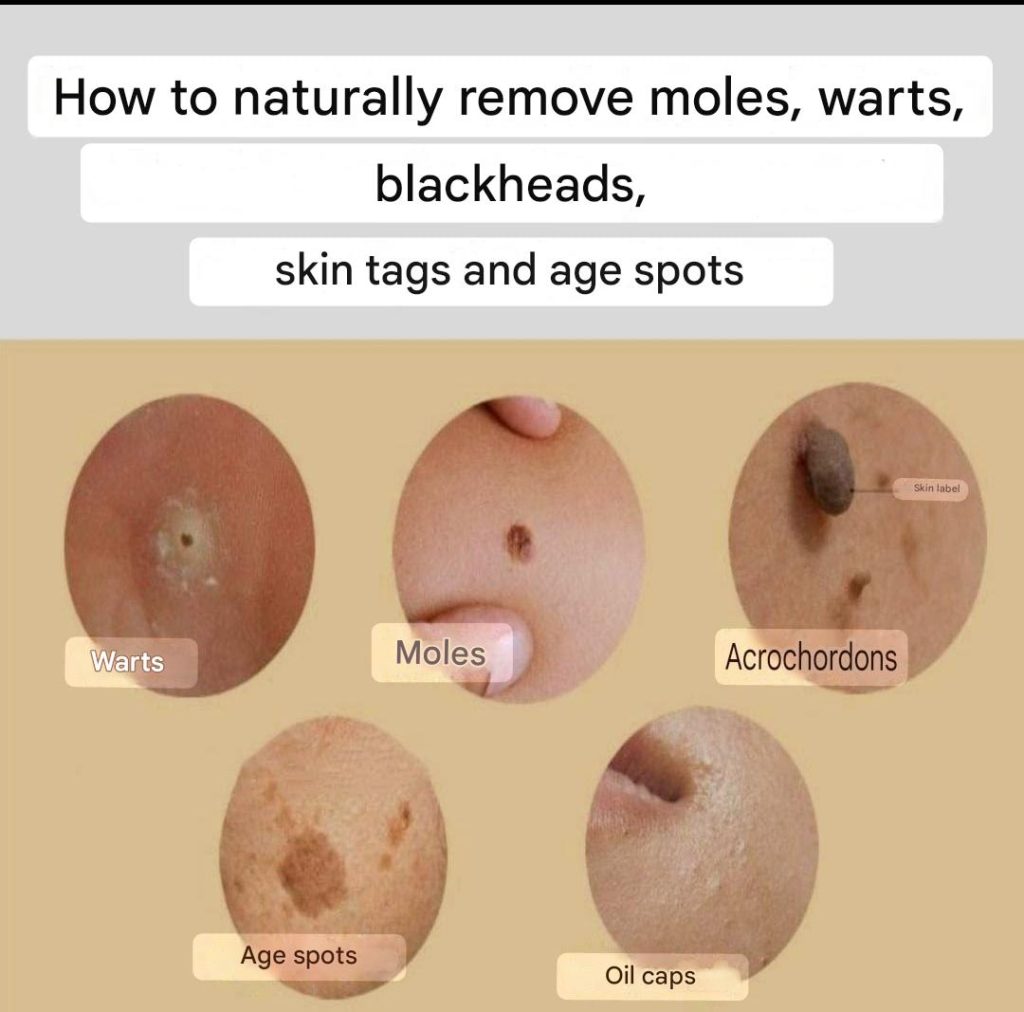 Natural Skin Care: What Can You Try to Remove Age Spots, Moles, Skin Tags, Warts and Blackheads?