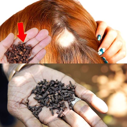 Unlock the Power of Cloves for Healthy Hair: Say Goodbye to Expensive Treatments