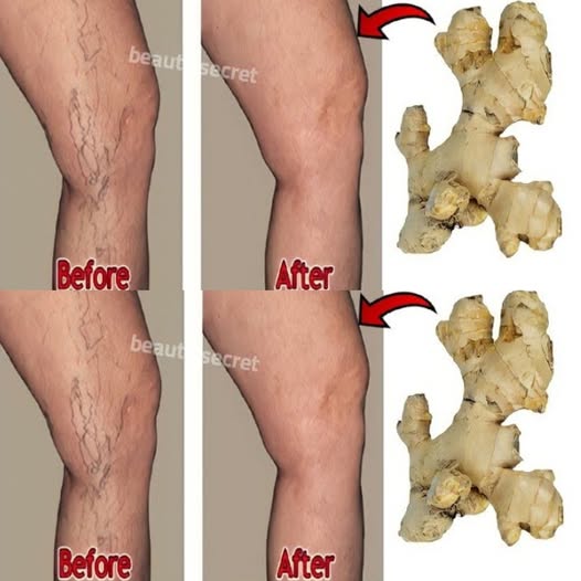 Say Goodbye to Varicose Veins and Joint Pain with Garlic and Olive Oil!