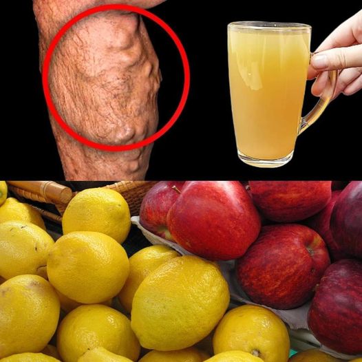 AM SHOCKED! Instantly Dissolves Blood Clots and Makes the Blood Fluid with Apple and Lemon Juice!