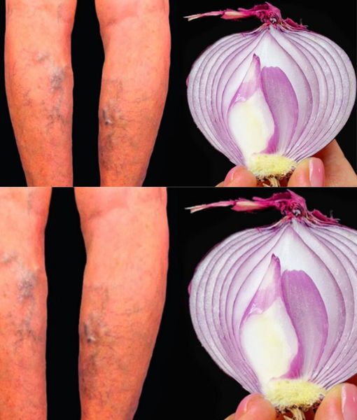 It’s a varicose vein killer! Erases varicose veins like magic.