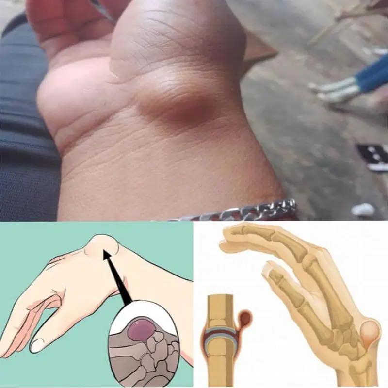 Understanding Wrist Ganglion Cysts: Causes, Symptoms, and Treatment Options