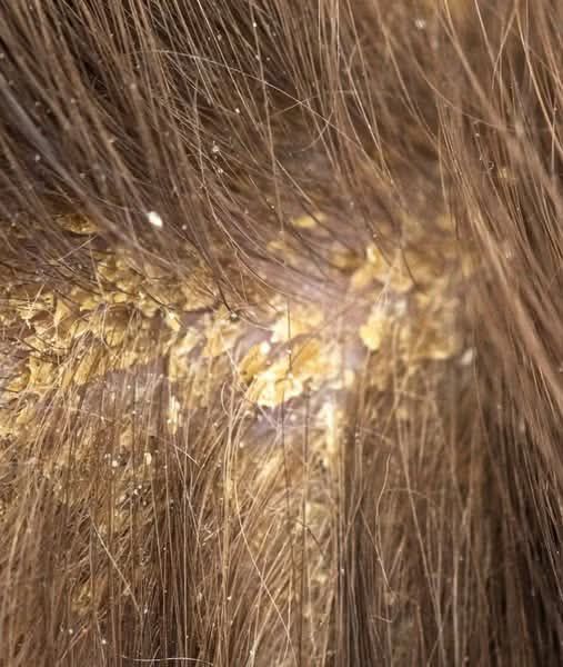 Dealing with Scalp Flakes and Itchiness? Here’s What You Can Do