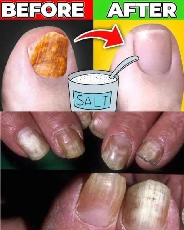 Effective Remedy with Baking Soda, Vinegar, and Tea Tree Oil