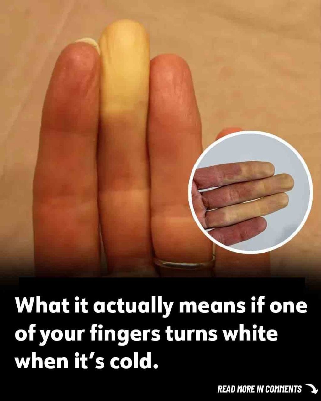 Why Does Your Finger Turn White in the Cold? Here’s What It Means