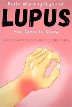 Recognizing the Red Flags: 8 Early Warning Signs of Lupus