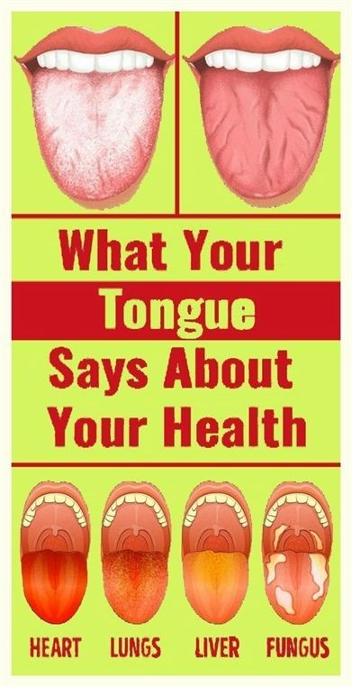 What Your Tongue Says About Your Health